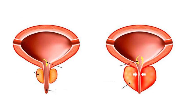 Normal prostate and inflammation