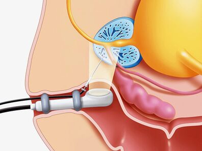 Biopsy of prostate gland puncture