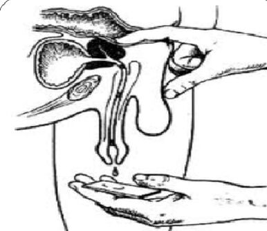 Massage the prostate gland to obtain secretion