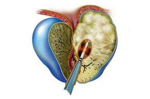 manifestations of acute prostatitis