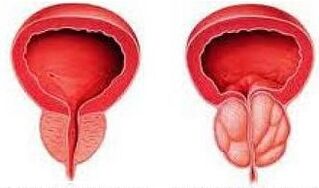 A healthy and inflamed prostate