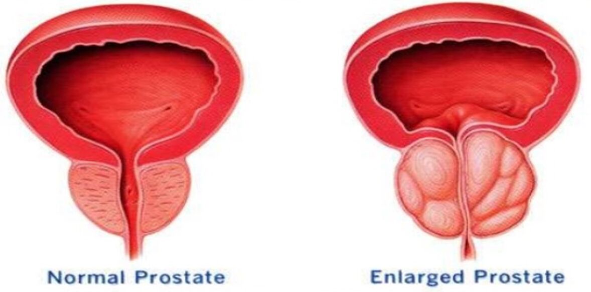 Normal prostate, prostate inflammation